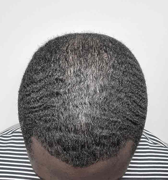 Male, 35, after