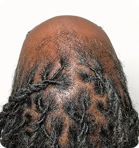 Female, 43, before