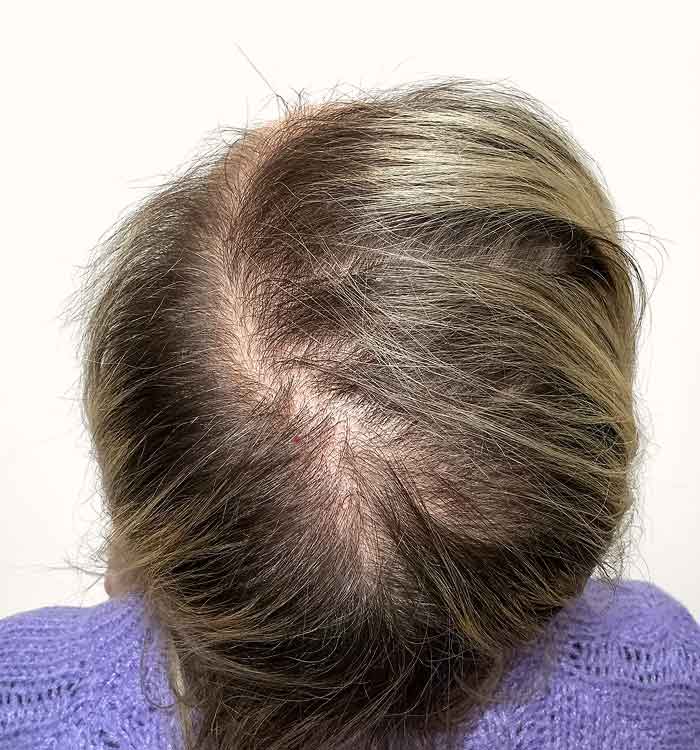 Female, 44, before