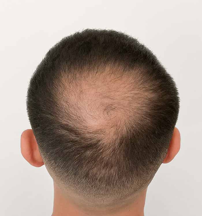 Male, 31, before