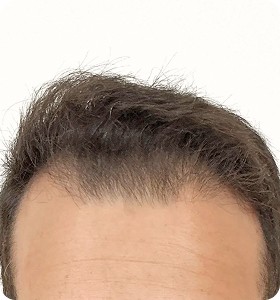 Male, 29, before